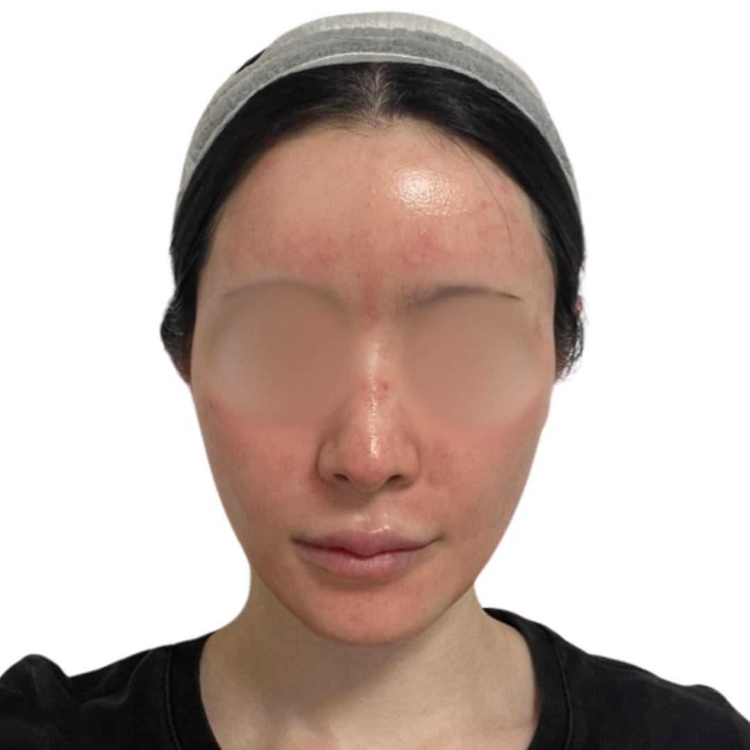 エクソソームフェイシャル